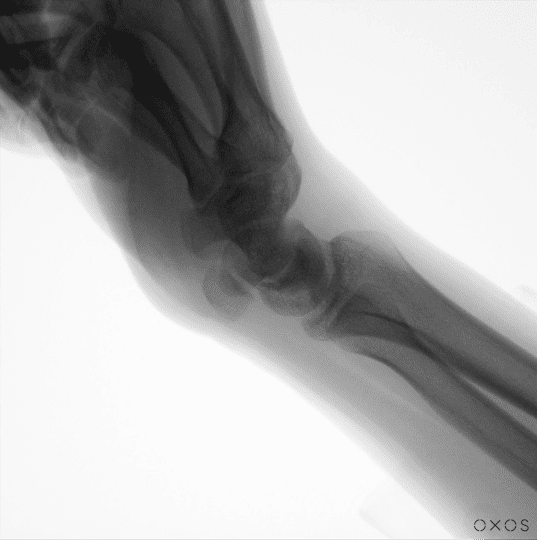 Wrist DDR