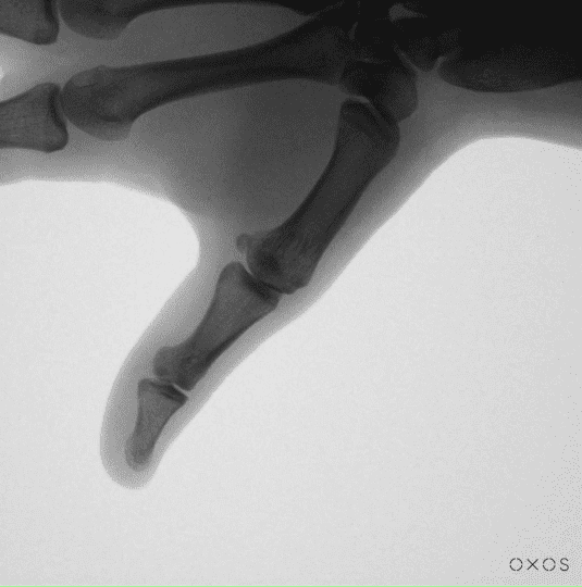 Result of Thumb X-ray Using Micro C