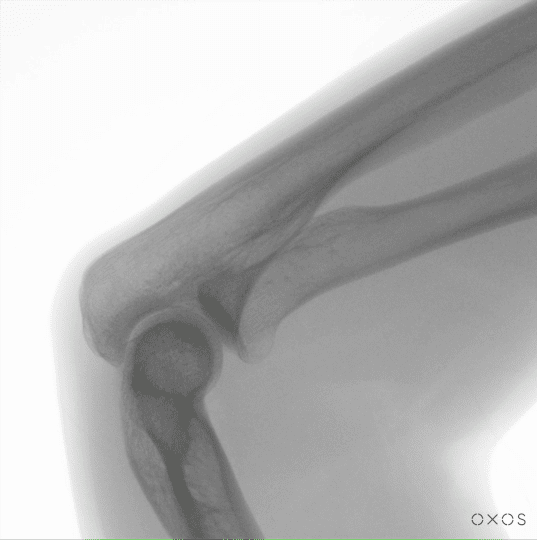 Elbow DDR