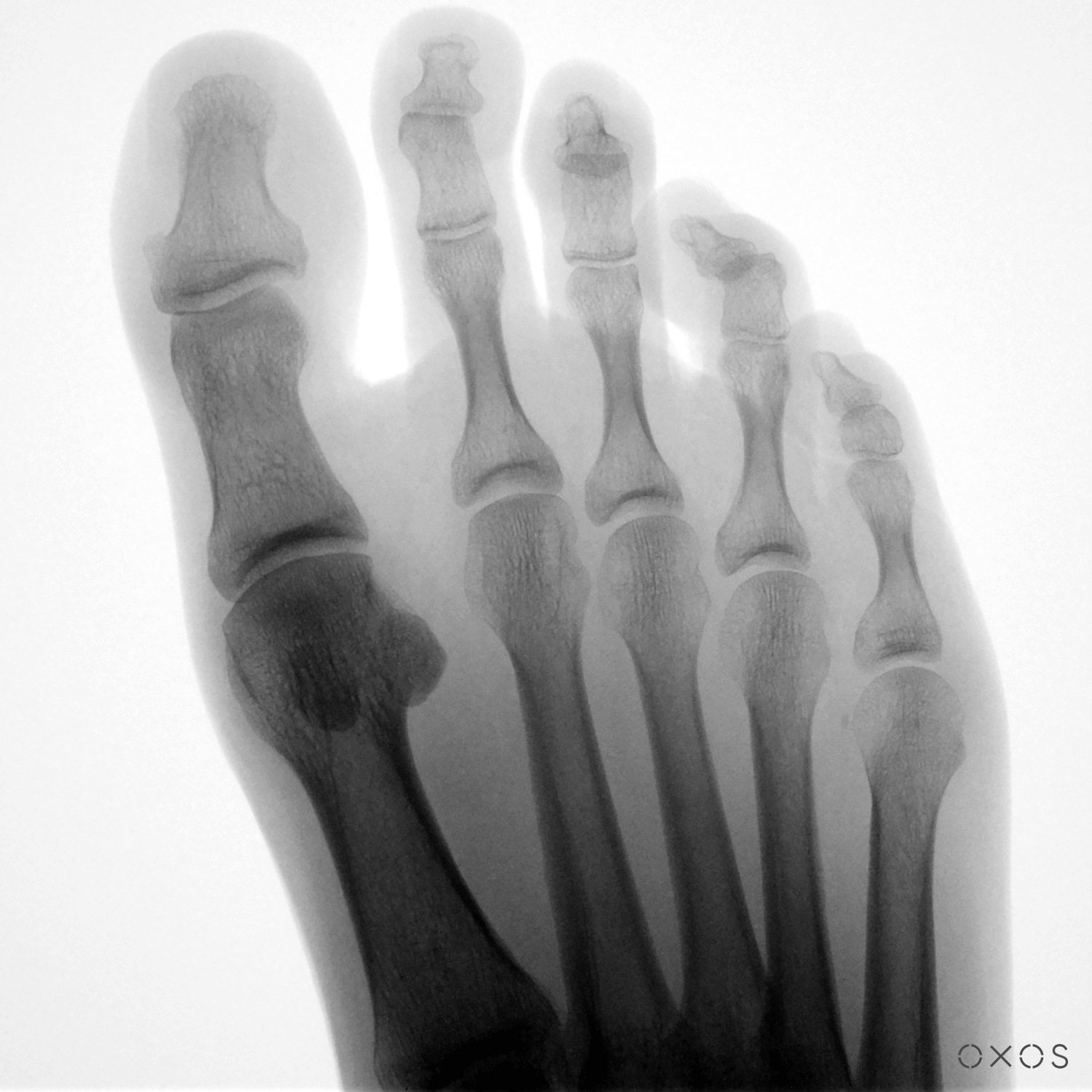 Foot, 13.7 µGy
