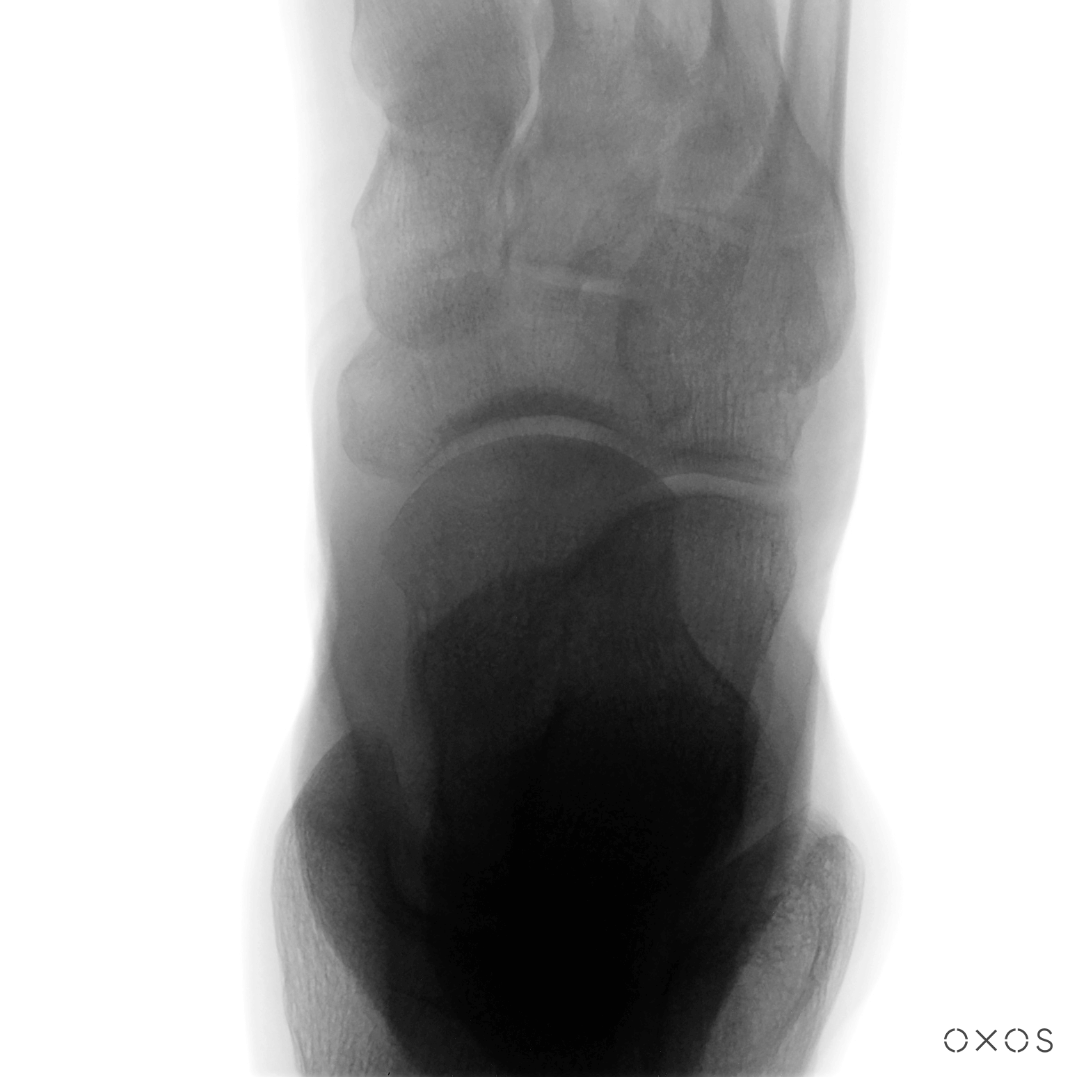 Midfoot, 13.7 µGy