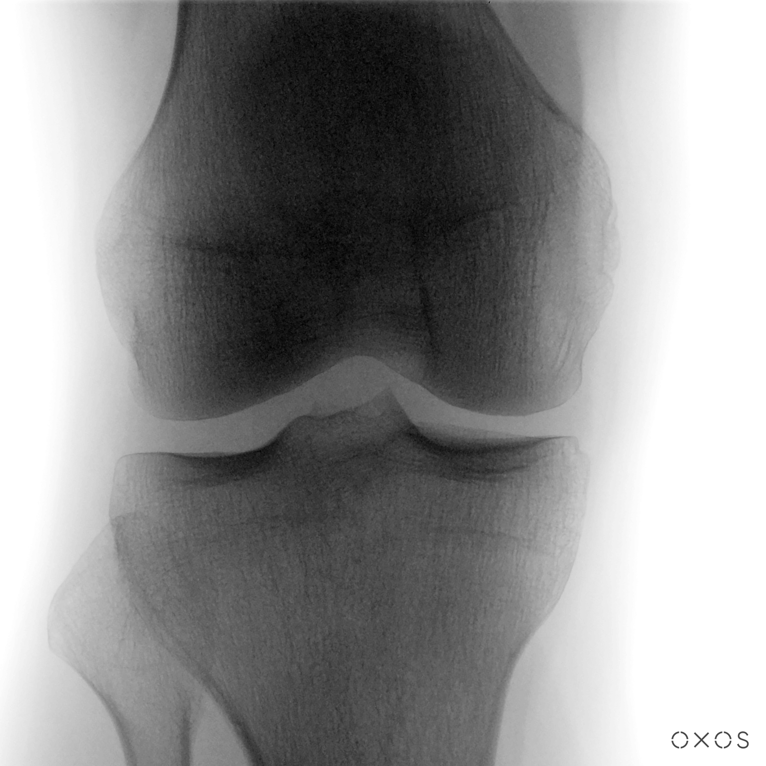Knee AP, 23.4 µGy