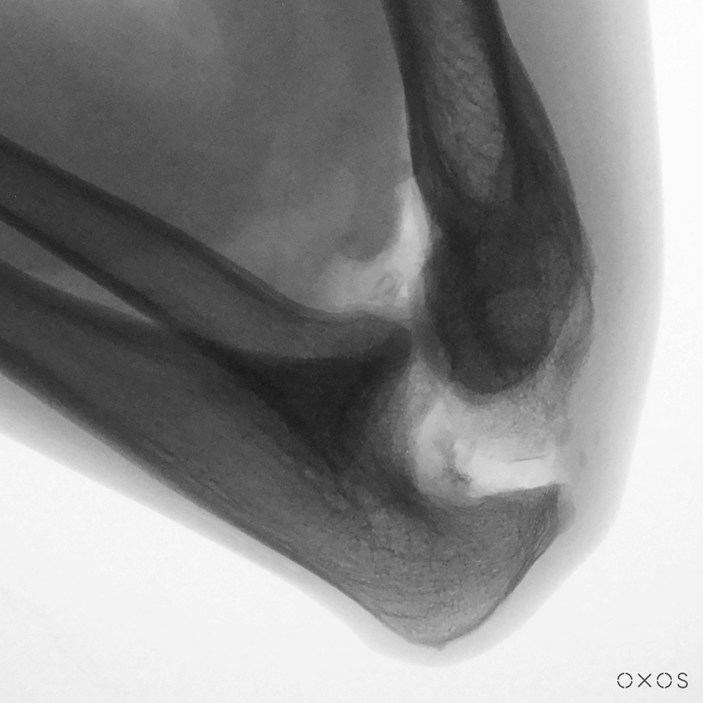 Elbow, Lateral, 9.7 µGy