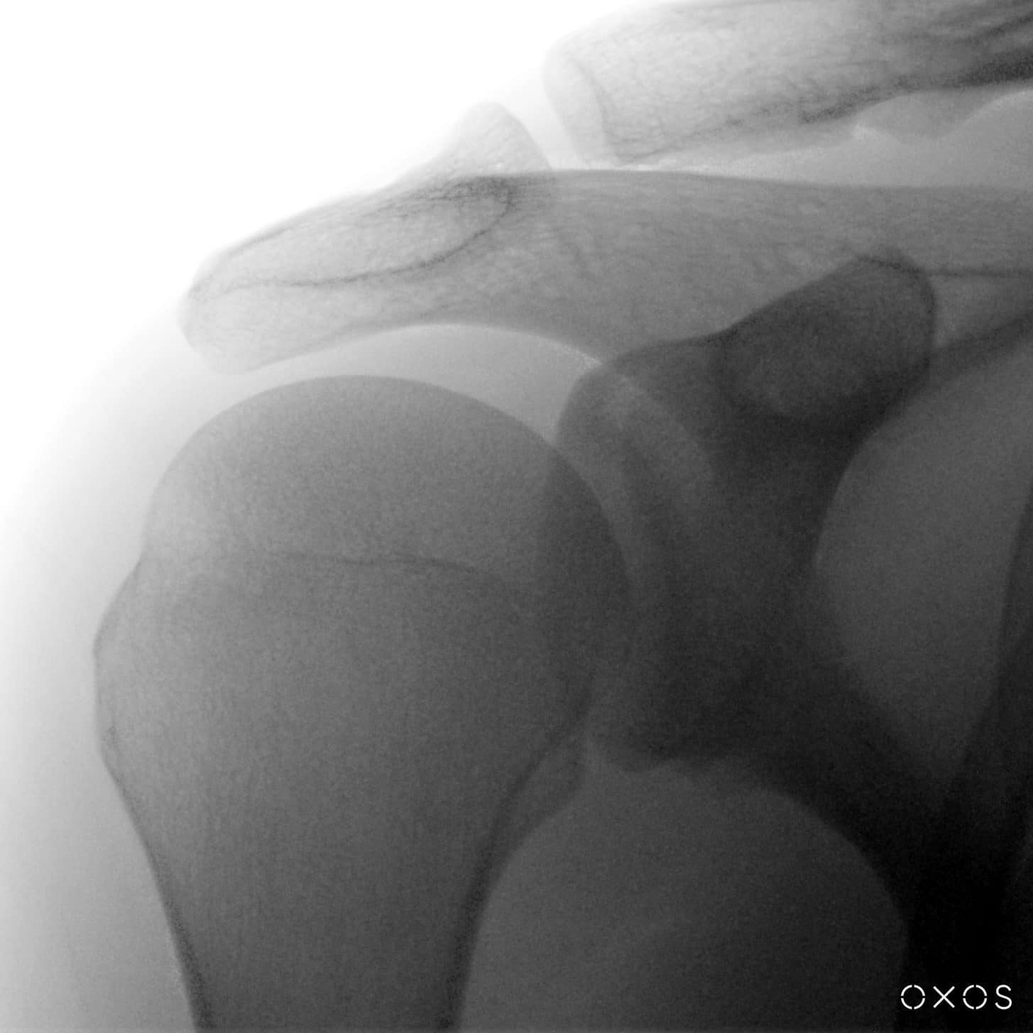 Shoulder, Grashey View, 17.4 µGy