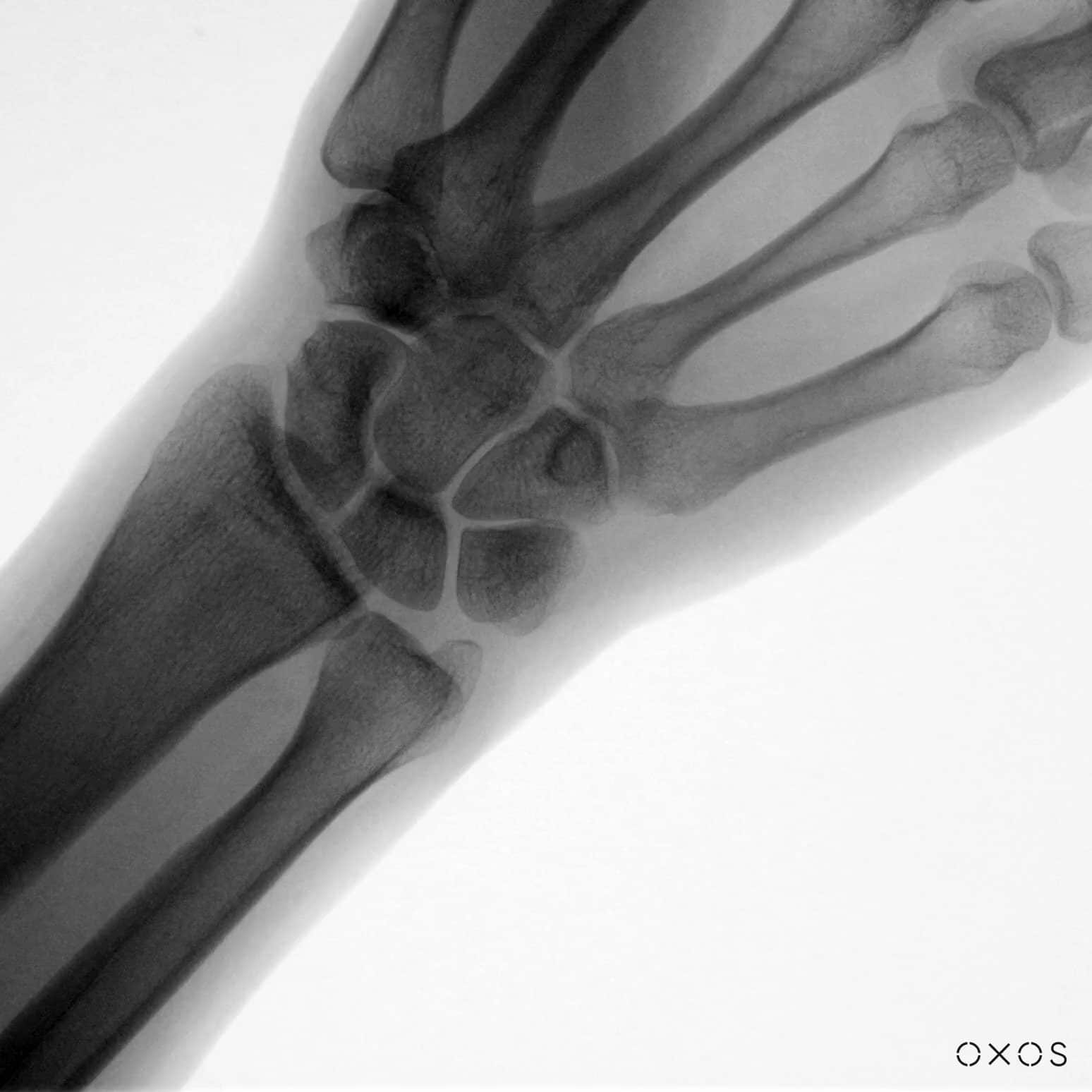 Wrist Rotation DDR
