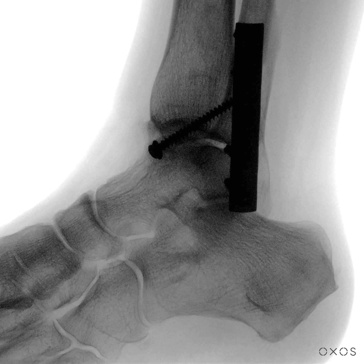 Ankle Capture with Micro C, Low Radiation Mode